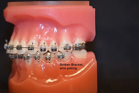 dental wire with metal brackets around molar|broken braces wire replacement.